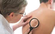 Se uma mancha não desaparecer e, ao contrário, crescer, vale a pena consultar um dermatologista - iStock